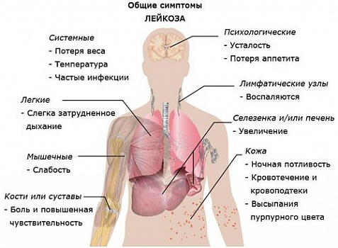 Первичная диагностика острых лейкозов Первичная диагностика острых лейкозов